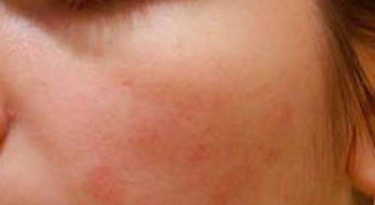 Príznaky a liečba kožných alergií vo forme červených škvŕn a svrbenia
